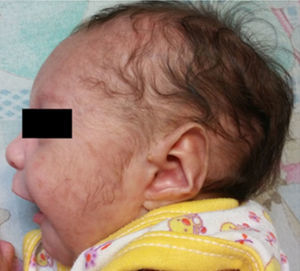 Paciente a los 3 días de vida. Micrognatia oreja de implantación baja con hélix aplando, apéndice preauricular.
