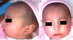 Paciente a los 6 mesesde edad. A. frente prominente, micrognatia. B. Hpertelorismo, labio superior adelgazado en “arco de cupido”. ceias arqueadas.