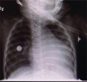 Radiografía de tórax con cardiomegalia.