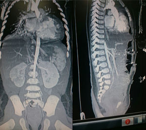 Angiotomografía con defecto de llenado de la aorta abdominal a nivel de la bifurcación y el origen de las 2 iliacas causado por un trombo «en silla de montar» (corte sagital y coronal).
