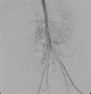 La arteriografía en aorta descendente por vía braquial muestra un defecto de llenado de la aorta abdominal a nivel de la bifurcación y el origen de las 2 iliacas causado por un trombo «en silla de montar».
