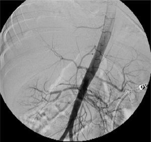 La arteriografía en la aorta descendente por vía femoral derecha demostró remisión total del trombo de la aorta abdominal y determinó la estenosis de la arteria renal derecha.