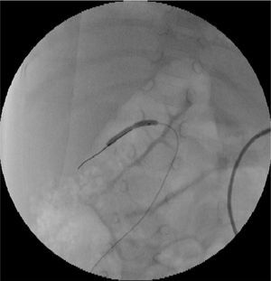 Angioplastia con balón en la estenosis de la arteria renal derecha.