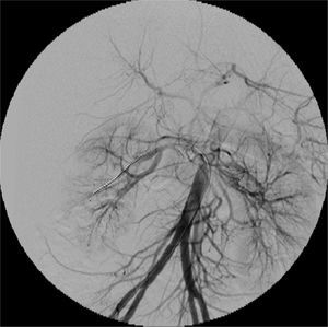 Arteriografía de control final. Se observa resolución de la estenosis de la arteria renal derecha, al igual que la aorta descendente libre de trombos.