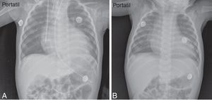 (A) Radiografía de tórax inicial donde se evidencia aumento del tamaño de la silueta cardiaca y (B) ultima radiografía donde se evidencia disminución del tamaño de la silueta cardiaca.