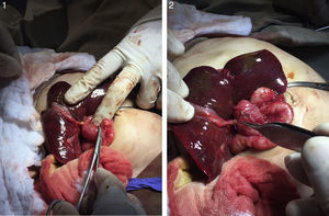Procedimiento quirúrgico: se realizó una incisión trasversa, se abordó cavidad abdominal evidenciando masa retroperitoneal, con disección de estructuras vasculares y separación de colon trasverso.
