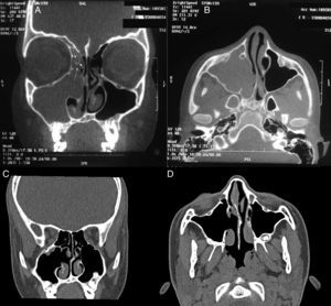 A y B. Tomografía computarizada coronal y axial preoperatoria de senos paranasales: se aprecia un desaparición opacificación total del seno maxilar, las celdillas etmoidales anteriores y el corredor nasal derecho, con abultamiento de la pared lateral nasal de ese lado, asociada a desaparición importante de la pared ósea. En la proyección coronal (A) se observa un área de calcificación focal o hiperostosis (flechas), localizada en la pared lateral nasal y la cavidad etmoidal. Este signo puede indicar el punto de origen del papiloma invertido y, en algunos casos, ser sugestivo de transformación maligna asociada. B y C. Tomografía computarizada coronal y axial un año después de la intervención: se aprecia ‘neumatización’ de las cavidades sinusales que habían estado comprometidas por la tumoración.