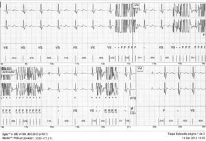 Telemetría del dispositivo que muestra “ruido” en el electrodo que fue interpretado como fibrilación ventricular y desencadenó la descarga del cardiodesfibrilador (marcado como HV).