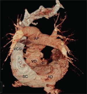Vista posterior con reconstrucción digital de angio-TAC en la que se evidencia vena cava superior izquierda persistente (VCSIP), seno coronario (SC), aurícula derecha (AD), tronco de arteria pulmonar y sus ramas principales (AP). Nótese la ausencia de vena cava superior derecha.