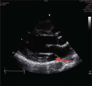 Vista paraesternal eje largo en la que se aprecia dilatación del seno coronario dilatado (flecha).