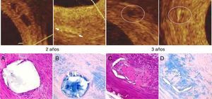 Imágenes de tomografía de coherencia óptica e histología a los dos y tres años de seguimiento después del implante de PB Absorb BVS.