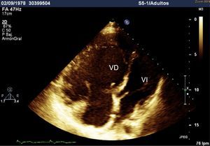 Proyección de cuatro cámaras; se observa la relación entre los ventrículos derecho e izquierdo. VD: ventrículo derecho; VI: ventrículo izquierdo.