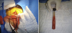 Apariencia macroscópica de la colección durante el drenaje y explante del dispositivo.