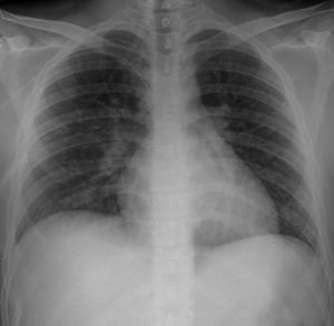 Radiografía de tórax anterolateral tomada al ingreso. Se evidencia infiltrado intersticial en ambos campos pulmonares, predominante en el lado izquierdo, que corresponde a cambios por edema pulmonar.