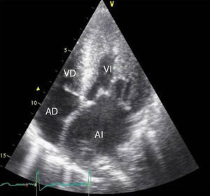 Ecocardiografía bidimensional apical 4 cámaras. Se nota dilatación importante de la aurícula izquierda (AI) e hipertrofia miocárdica del ventrículo izquierdo (VI). AD: aurícula derecha; VD: ventrículo derecho.