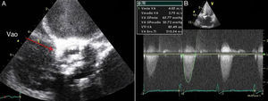A) Imagen de válvula aórtica por ecocardiografía transesofágica, eje corto, obtenida después del procedimiento de valvuloplastia con balón. Se nota calcificación extensa de las valvas y apertura valvular reducida. B) Gradiente sistólico aórtico máximo por Doppler continuo=66mm Hg, medio=35mm Hg. Vao: válvula aórtica.