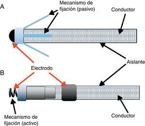 Construcción de un cable para estimulación. A)Electrodo unipolar de fijación pasiva. Observe la presencia de un solo electrodo, por lo cual el circuito se cierra con la carcasa del dispositivo. Este tipo de electrodo solo puede ser configurado en estimulación unipolar. El mecanismo de fijación pasiva por lo general está compuesto por pestañas pequeñas que se enredan en las trabéculas musculares y que posteriormente, al ser cubiertas por el endocardio y el tejido fibroso, quedan adheridas al músculo cardíaco. B)Electrodo bipolar de fijación activa. Observe la presencia de 2 electrodos, lo cual le permite cerrar el circuito sin ser necesaria la participación de la carcasa. Adicionalmente, su sistema de fijación está compuesto por un mecanismo en forma de tirabuzón que se introduce mecánicamente dentro del miocardio. Este mecanismo cuenta además con un reservorio con esteroide que disminuye la reacción inflamatoria y el riesgo de fibrosis en el sitio del implante (este último se asocia con aumento en el umbral de estimulación).