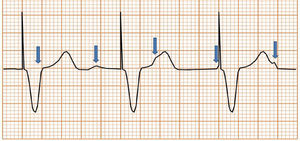 Marcapasos ventricular en modo unipolar. Se observa estímulo del dispositivo previo al QRS (ritmo de estimulación ventricular). Dado que no hay un cable auricular, no se preserva la sincronía AV, lo que se observa como ausencia de relación entre las ondas P (flechas azules) y los complejos ventriculares. En el modo VVI, la presencia de QRS intrínseco inhibe al marcapasos.
