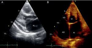 Ecocardiografía. A) Imagen en eje paraesternal longitudinal, que muestra compromiso por la fibrosis en la pared inferolateral del ventrículo izquierdo (VI) y compromiso de los músculos papilares. Válvula mitral engrosada y con movilidad reducida. B) Imagen apical de cuatro cámaras; nótense marcada dilatación biauricular, obliteración fibrótica del ápex del ventrículo derecho, fibrosis en paredes lateral y apical septal y compromiso del músculo papilar. AD: aurícula derecha; AI: aurícula izquierda; AO: aorta; VD: ventrículo derecho; VI: ventrículo izquierdo.