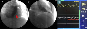 Cateterismo. A) Imagen de hemodinámica que muestra amputación de la punta del ventrículo derecho (flecha). B) Imagen de hemodinámica que muestra cavidad cardiaca izquierda reducida de tamaño por la fibrosis miocárdica. C) La curva de presión ventricular derecha muestra imagen en raíz cuadrada.