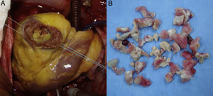 Pieza quirúrgica. A) Imagen de la camada fibrosa extensa visualizada a través de ventriculotomía izquierda. B) Imagen de la camada fibrosa extraída mediante cirugía.