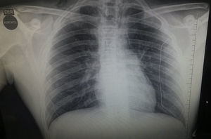 Radiografía de tórax anteroposterior que muestra línea radiolúcida hacia ápex pulmonar bilateral sugestiva de neumomediastino.