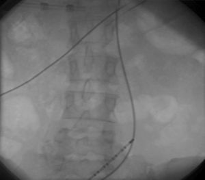 Catéteres de ablación dirigidos a la izquierda de la columna vertebral, indicando recorrido venoso anómalo por agenesia de vena cava inferior (demostrado posteriormente por venografía –figura 3–).