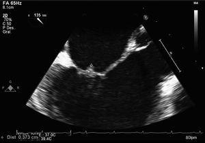 Proyección medio esofágica eje largo con la válvula aórtica abierta, en la que se observa imagen ecodensa que protruye 4mm en la superficie auricular de la válvula mitral.