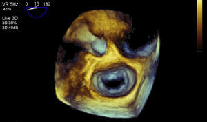 Ecocardiografía tridimensional después del tratamiento inmunosupresor en la que observa resolución del engrosamiento de la superficie valvular.