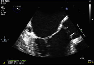 Proyección medio esofágica eje largo después del tratamiento, en la que se evidencia desaparición de la vegetación en la valva anterior de la mitral.