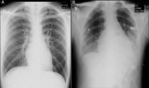 A) Radiografía de tórax en el ingreso normal. B) Radiografía de tórax control con signos de hipertensión pulmonar poscapilar, aumento de la silueta cardiomediastínica y derrame pleural bilateral.