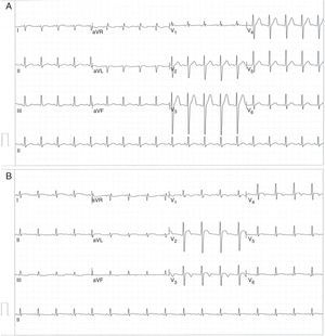 A) Electrocardiograma de ingreso con taquicardia sinusal. B) Electrocardiograma control con taquicardia sinusal, trastorno difuso de la repolarización, trastorno de la conducción intraventricular, intervalo QTc prolongado y en las derivaciones de V2 a V4 cambios en el ST con inversión de la onda T.