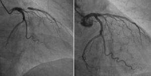 Angiografía coronaria con lesión severa proximal de la descendente anterior.