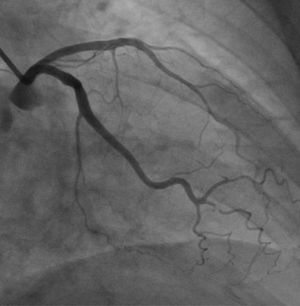 Angiograma mostrando coronaria izquierda sin lesiones.