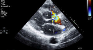 Ecocardiografía donde se evidencia el aneurisma del seno de Valsalva extendiéndose hacía el septo interventricular. El doppler color muestra el flujo de la aorta al aneurisma. AI: aurícula izquierda, An: aneurisma del seno de Valsalva, Ao: aorta, VI: ventrículo izquierdo.