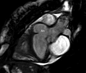 Resonancia magnética cardiaca que muestra el aneurisma del seno de Valsalva (An).