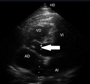 Ecocardiografía transtorácica. Vista apical de 4 cámaras. Se observa prolapso del septo interventricular membranoso hacia el ventrículo derecho (flecha). AD: aurícula derecha; AI: aurícula izquierda; VD: ventrículo derecho; VI: ventrículo izquierdo.