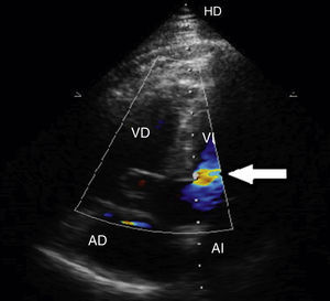 Ecocardiografía transtorácica. Vista apical de 4 cámaras. Doppler color a nivel de aneurisma, sin detectar cortocircuito a ese nivel (flecha). AD: aurícula derecha; AI: aurícula izquierda; VD: ventrículo derecho; VI: ventrículo izquierdo.