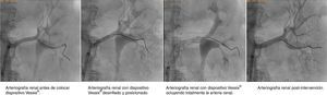 Arteriografías renales antes, durante y luego del procedimiento donde se evidencia la permeabilidad arterial y el posicionamiento del balón en las diferentes fases de la intervención.