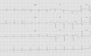 Electrocardiograma poscoronariografía de 1997. Presencia de QS en V1-V2, sin otros hallazgos anormales.