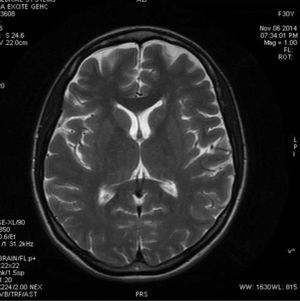 RNM cerebral: sin alteraciones. Imágenes axiales de RM potenciadas en T2 sin evidencia de alteraciones.