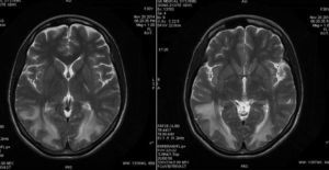 RNM cerebral: imágenes axiales de RM potenciadas en T2 donde se observa aumento de la señal subcortical y de la sustancia blanca en regiones frontales, parietales y occipitales, consistentes con edema vasogénico.
