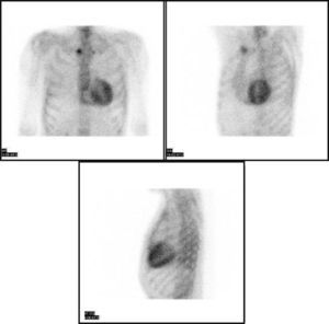 Gammagrafía cardiaca con 99mTc-DPD. En las diferentes proyecciones de la gammagrafía, tras la administración de 99mTc-DPD se observa el característico depósito a nivel cardiaco tanto en el ventrículo izquierdo como en el derecho.