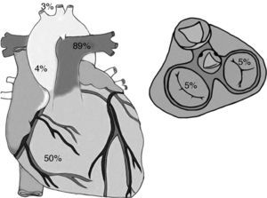Porcentaje de lesiones cardiacas relacionadas por área anatómica: el ventrículo derecho 50% de los casos, la válvula tricúspide 5% de los casos, el ligamento arterioso 89% de los casos, la aorta ascendente 4% de los casos y los troncos supraórticos 3% de los casos.