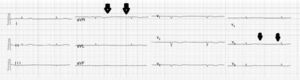 Electrocardiograma con bajo voltaje generalizado con evidencia de bloqueo auriculoventricular de tercer grado con ondas P (flechas) más evidentes en V5, con PR variable.
