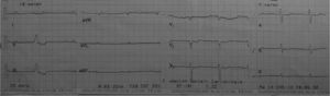 Electrocardiograma tras retirada del cardiorresincronizador con bajo voltaje, bloqueo AV de primer grado y extrasístole ventricular aislada.