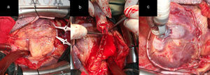 a) AMD anastomosada en T a la AMI in situ. b) Excelente flujo a través de ambos injertos (superior a 100mL/min). c) Logro de la revascularización arterial total con ambas arterias mamarias.