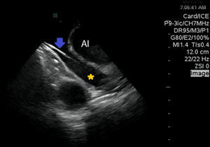Ecocardiografía intracardíaca donde se observa dilatación severa del seno coronario (estrella amarilla) que permite el libre movimiento de un catéter decapolar en su interior (flecha azul). AI: aurícula izquierda.