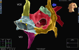 Reconstrucción tridimensional con sistema EnSite, en la cual se observa la dilatación severa del seno coronario (mostaza) al cual drena la vena cava superior izquierda (flecha azul). No se encontró conexión entre la vena cava derecha y la izquierda. Se pueden observar claramente las relaciones anatómicas, mientras la vena cava superior izquierda discurre dentro del pericardio en el surco ubicado entre el apéndice auricular izquierdo (verde) y las venas pulmonares izquierdas. AD: aurícula derecha; AI: aurícula izquierda; VCI: vena cava inferior; VCS: vena cava superior derecha.