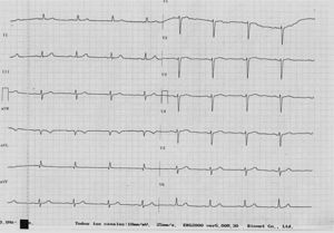 Electrocardiograma basal normal.